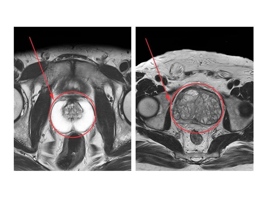 Comparison of healthy (left) and inflamed (right) prostate on MRI scans